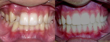 Cross Bite: A cross bite is when one or more of the top teeth sit behind the bottom teeth. Cross bites can occur in either the anterior (front) or posterior (back) teeth.