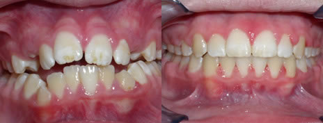 Open Bite: An open bite occurs when the upper anterior (front) teeth do not meet the lower anterior teeth. This can be due to Tongue Thrust, Thumb/Finger Sucking Habits, or Prolonged Pacifier/Bottle use.