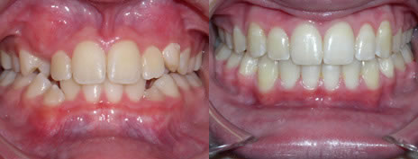 Crowding: Crowding is a very common reason for people to seek Orthodontic Treatment. Teeth may become rotated, or simply overlap when there is not enough room for them.