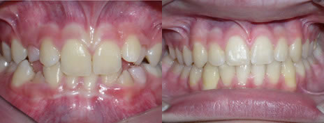 Deep Bite: A deep bite occurs when the upper teeth cover too much of the lower teeth.