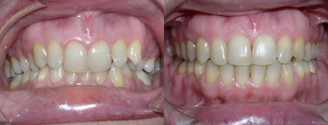 Deep Bite: A deep bite occurs when the upper teeth cover too much of the lower teeth.