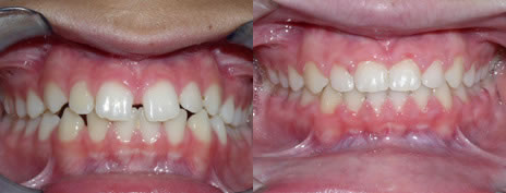 Diastema: A diastema is a gap between the front teeth.