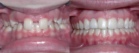 Diastema: A diastema is a gap between the front teeth.